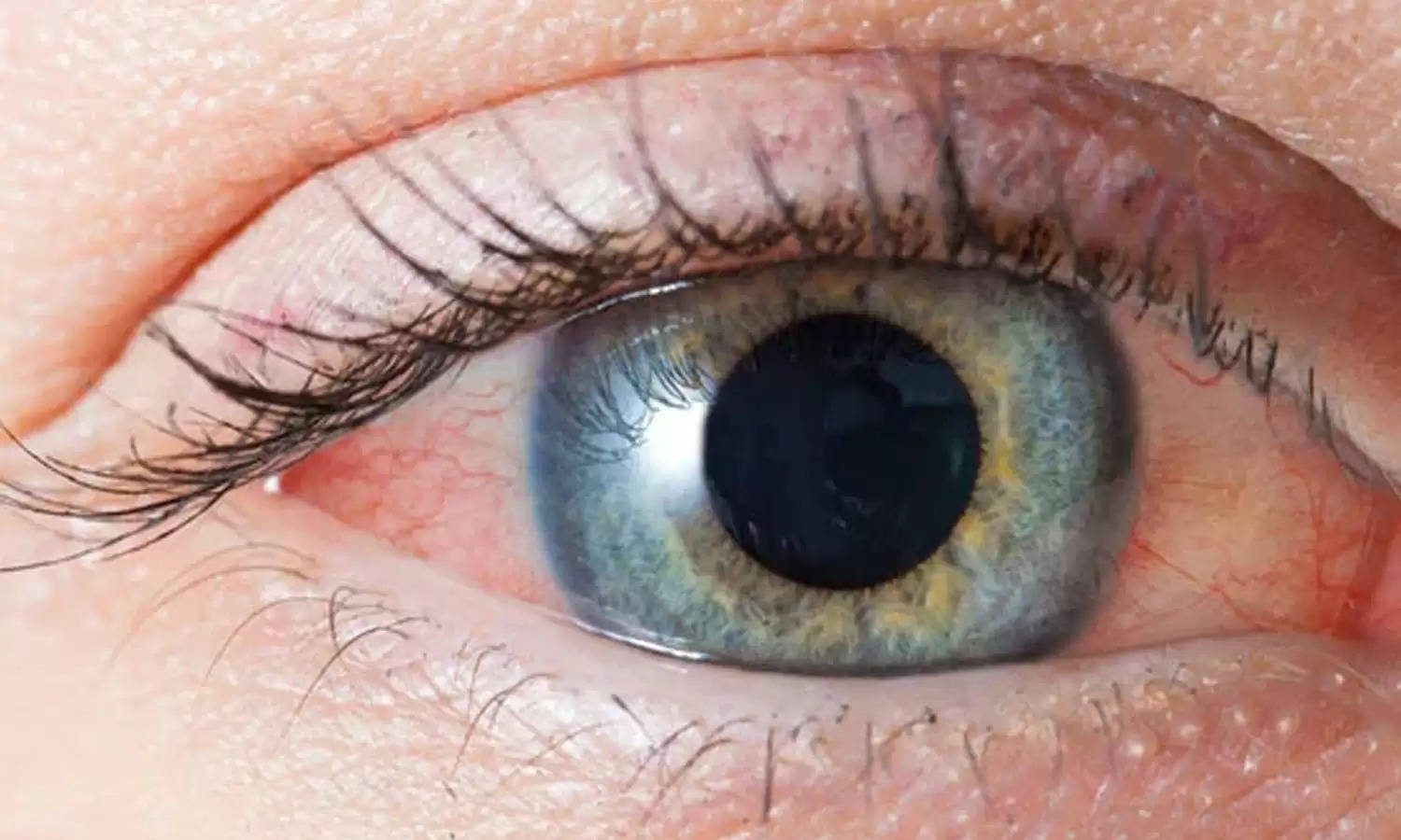 गंभीर समस्या का संकेत हो सकता है आंखों का लालपन, समय रहते सावधान हो जाइए