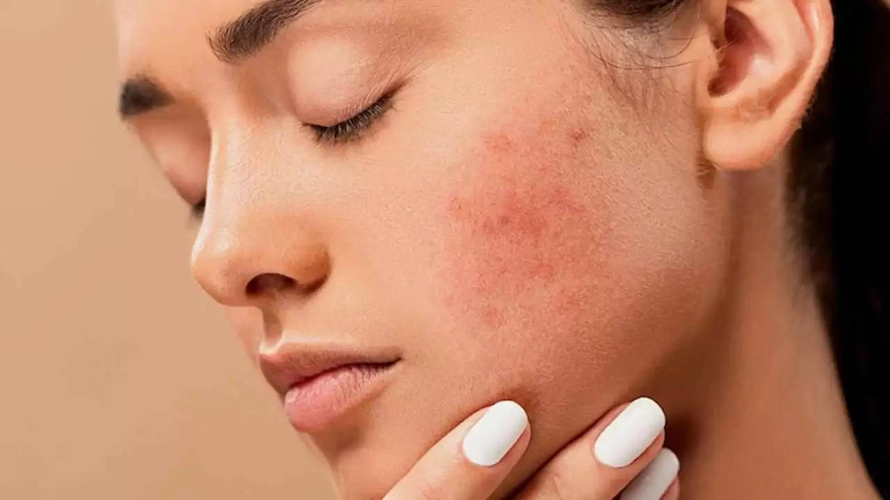 Pimple Home Remedies: त्वचा के दाग-धब्बों से छुटकारा दिलाएंगे यह घर के बने मास्क, नोट कीजिए इनको तैयार करने का नुस्खा