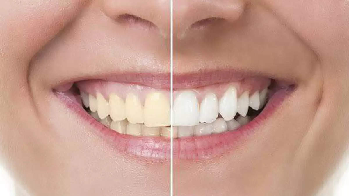 Teeth Whitening: आज ही दांतों का पीलापन करें दूर, एक चमकदार मुस्कान के लिए आजमाएं ये उपाय 